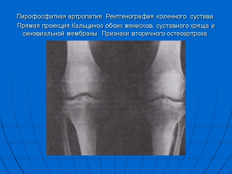 Пирофосфатная артропатия. Рентгенография коленного сустава. Прямая проекция.Кальциноз обоих менисков, суставного хряща и синовиальной мембраны.